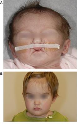 DNA methylation differences in monozygotic twins with Van der Woude syndrome